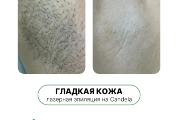 Скидки на эпиляцию на аппарате Candela